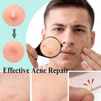 Zemolo 300pcs Pimple Patches Spot Patches Acne Hydrocolloid Salicylic Acid, Acne Absorbing Invisible Stickers，Cover Dot for Pimples Whiteheads Day & Night