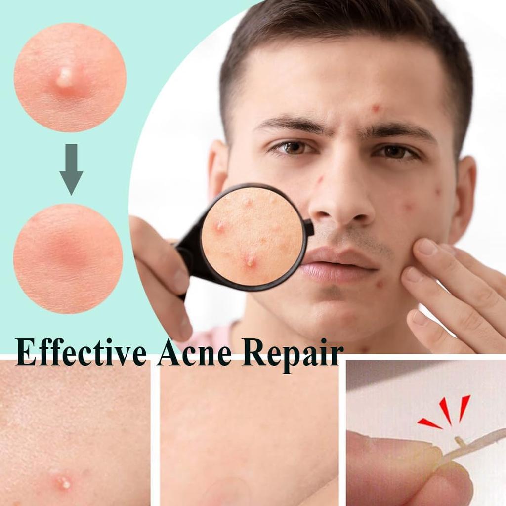 Zemolo 300pcs Pimple Patches Spot Patches Acne Hydrocolloid Salicylic Acid, Acne Absorbing Invisible Stickers，Cover Dot for Pimples Whiteheads Day & Night