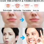 Zemolo 300pcs Pimple Patches Spot Patches Acne Hydrocolloid Salicylic Acid, Acne Absorbing Invisible Stickers，Cover Dot for Pimples Whiteheads Day & Night