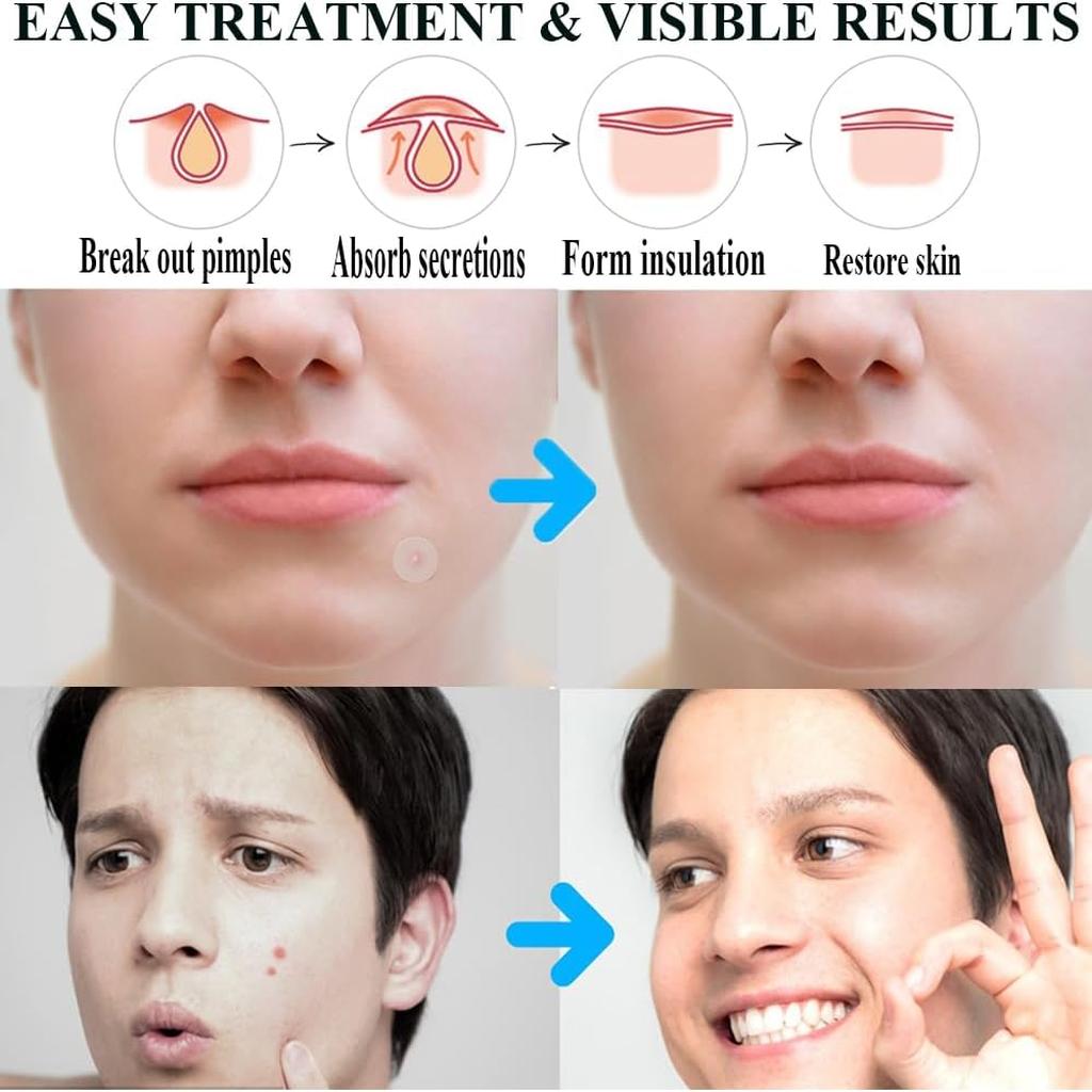 Zemolo 300pcs Pimple Patches Spot Patches Acne Hydrocolloid Salicylic Acid, Acne Absorbing Invisible Stickers，Cover Dot for Pimples Whiteheads Day & Night