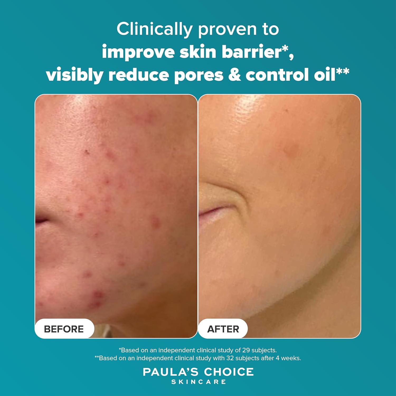 Paula's Choice SKIN PERFECTING 2% BHA Liquid Exfoliant - Face Exfoliating Peel Fights Blackheads & Enlarged Pores - for a Healthy Glow - with Salicylic Acid - Combination & Oily Skin - 30 ml